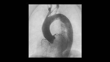 Aortic procedure