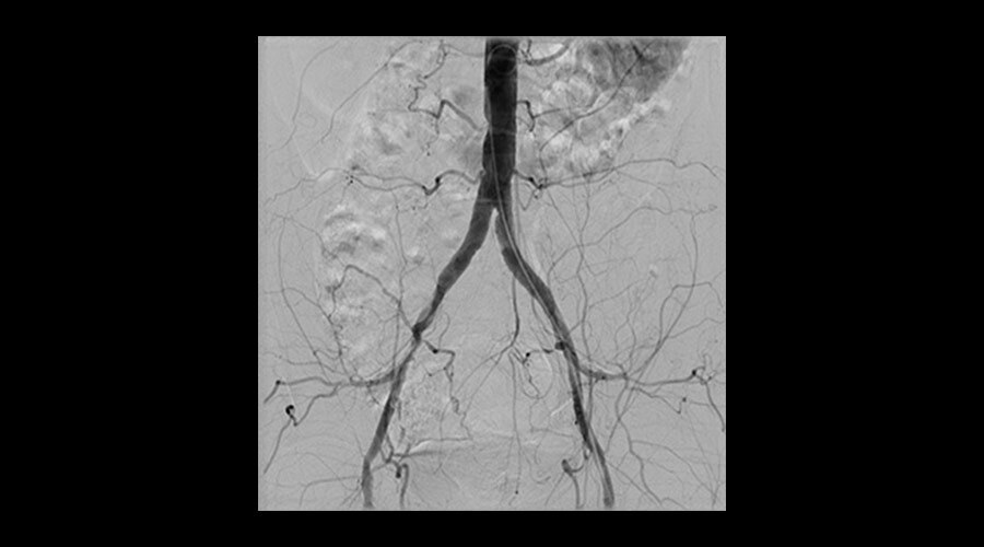 �liyak stentlemesi