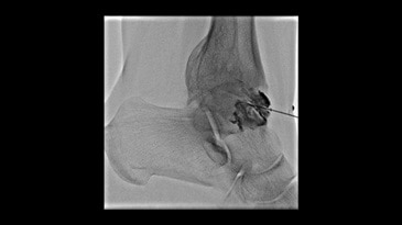 Infiltration treatment