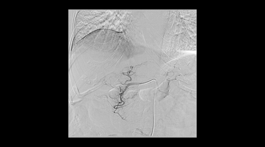 Karaci�er embolizasyonu