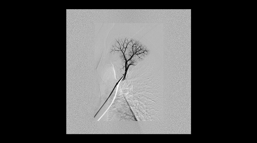 Akci�er embolizasyonu