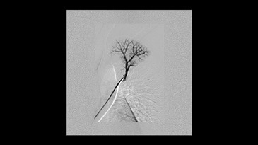 Akciğer embolizasyonu