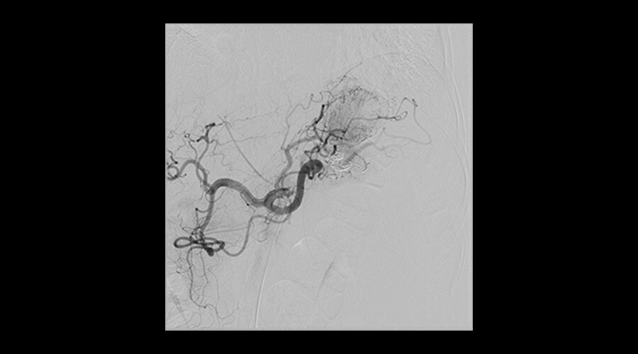 Splenik anevrizma tedavisi