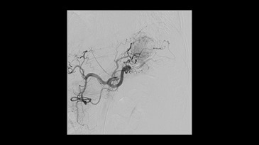 Splenik anevrizma tedavisi