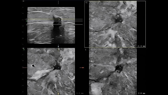 hotspot tours-logiq e9-speckle-reduction_jpg