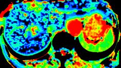 ileri görüntüleme ct perfusion 4d multi-organ.