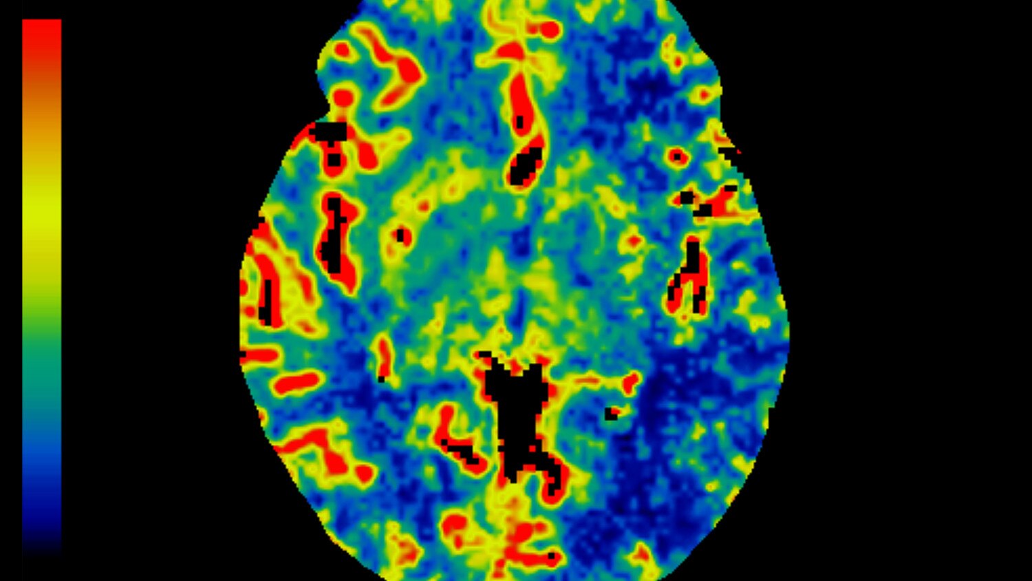 ileri görüntüleme ct perfusion 4d.