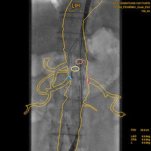 duct-categories-interventional-x-ray-igs-for-hybrid-or-discovery igs 730-evar-assist-2.jpg