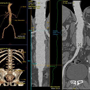 duct-categories-interventional-x-ray-igs-for-hybrid-or-discovery igs 730-evar-assist-3.jpg