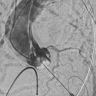 duct-categories-interventional-x-ray-igs-for-hybrid-or-discovery igs 730-tavi-assist-1.jpg