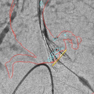 duct-categories-interventional-x-ray-igs-for-hybrid-or-discovery igs 730-tavi-assist-2.jpg