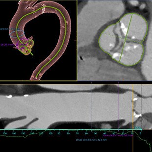 duct-categories-interventional-x-ray-igs-for-hybrid-or-discovery igs 730-tavi-assist-3.jpg