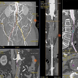 t-categories-interventional-x-ray-igs-for-hybrid-or-discovery igs 730-plan-evar-assist.jpg