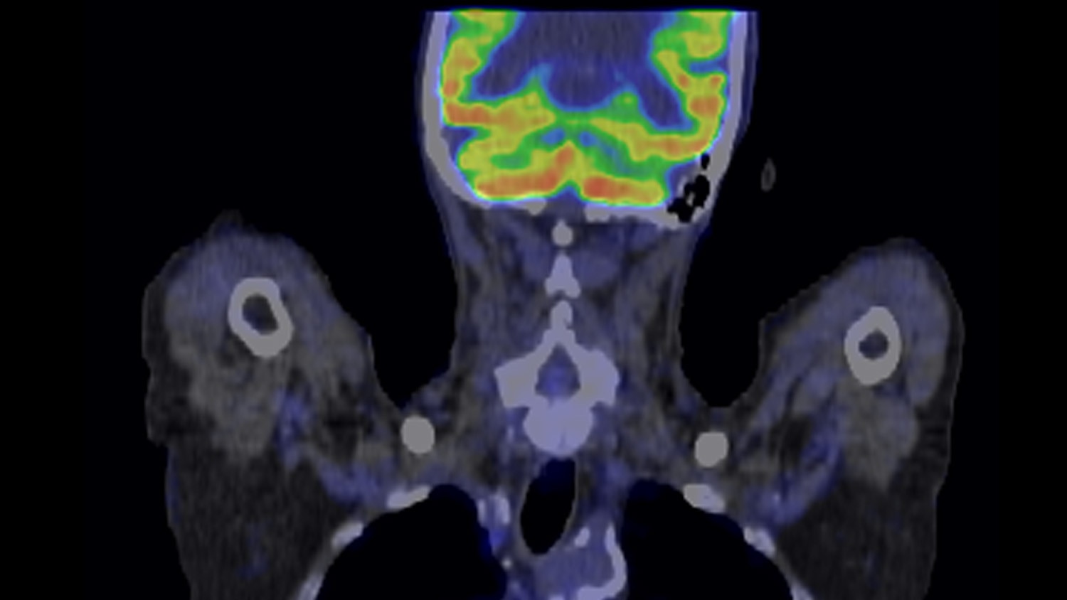 product-product-categories-pet-ct-qclear-gehc-qclear-case4_thumbnail.jpg